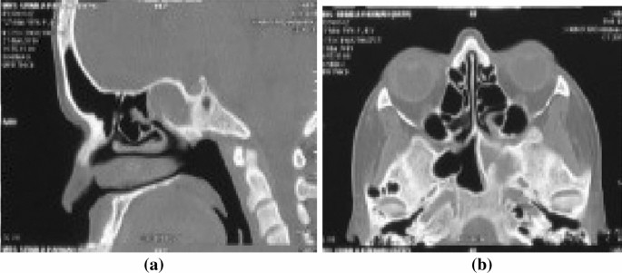Isolated Sphenoid Sinus Mucocele With Occular Symptoms A Case Series Springerlink Isolated Sphenoid Sinus Mucocele With Occular Symptoms A Case Series Springerlink