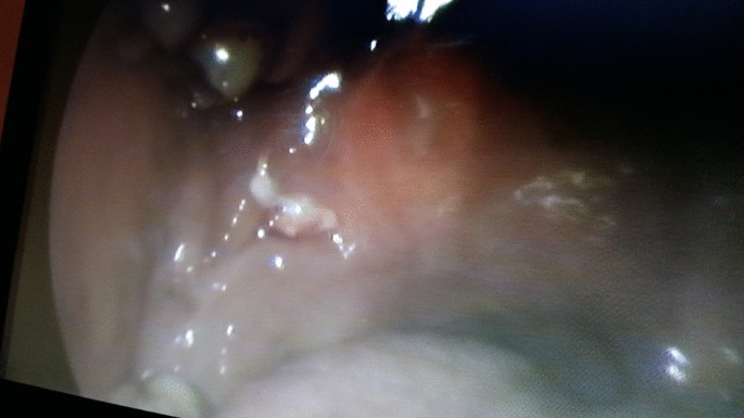 Endoscope Vore