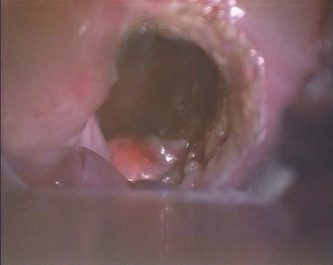 Endoscope Vore