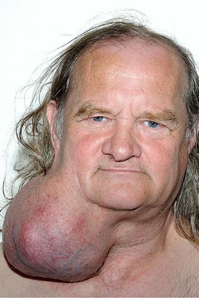 Prostatitis gondolatok