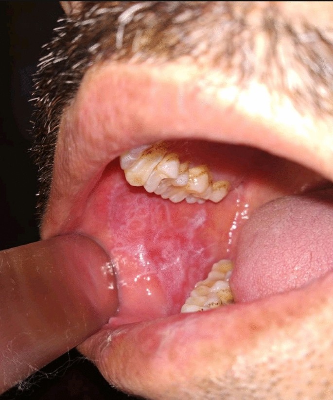 Reticular Oral Lichen Planus: A Clinical Experience of ENT Surgeons |  SpringerLink