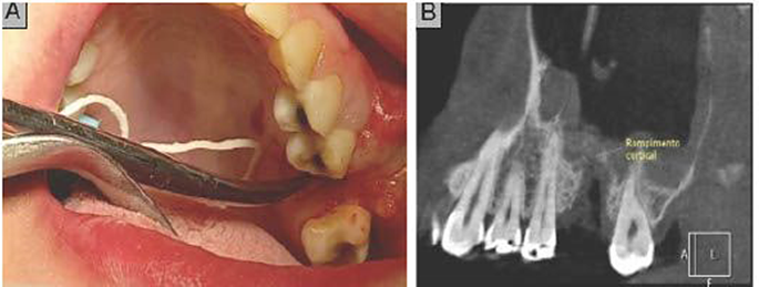 Therapeutic Strategies in Recurrent Oral and Sinusal Fistulas: Case ...
