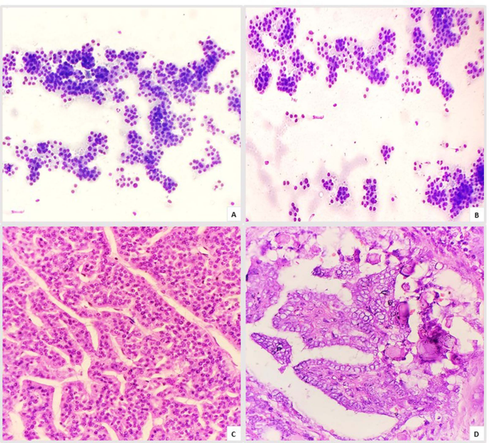 Synchronous Papillary and Oncocytic Thyroid Carcinomas: An Unusual ...
