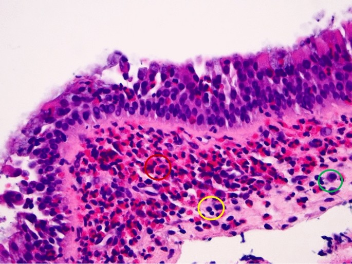 Endotype Characterization of Chronic Rhinosinusitis with Nasal Polyps ...