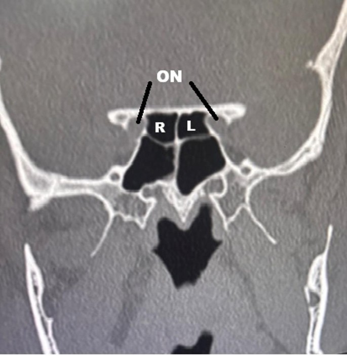 Anatomical Intricacies of the Sphenoid Sinus in Kashmiri population: A ...