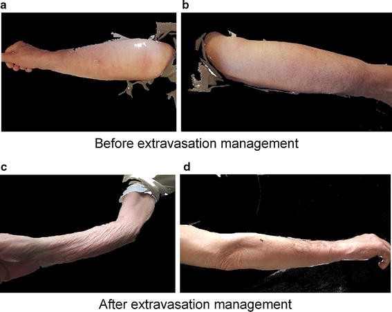 Management Of Extravasation Of Oxaliplatin By Mimicking Its Biotransformation Springerlink