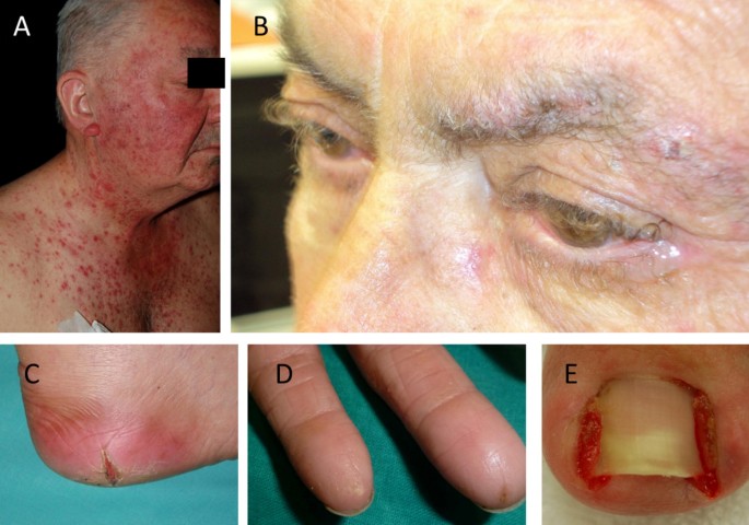 Clinical Management Of Cutaneous Adverse Events In Patients On