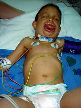 Paraphenylene Diamine Hair Dye Poisoning: An Uncommon Cause of Rhabdomyolysis | SpringerLink Paraphenylene Diamine Hair Dye Poisoning: An Uncommon Cause of Rhabdomyolysis | SpringerLink