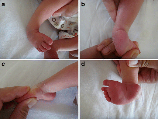 Congenital Clubfoot Early Recognition And Conservative Management For Preventing Late Disabilities Springerlink