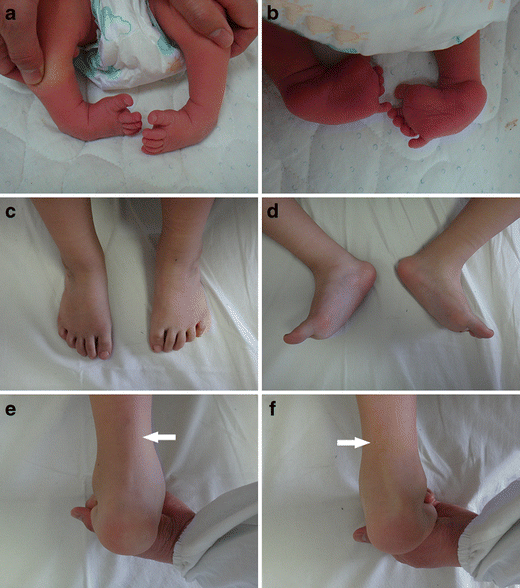 Congenital Clubfoot Early Recognition And Conservative Management For Preventing Late Disabilities Springerlink