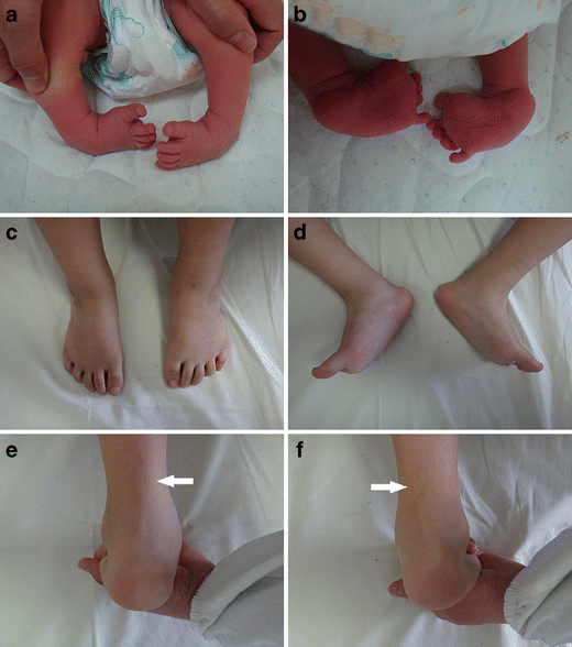 Congenital Clubfoot Early Recognition And Conservative Management For Preventing Late Disabilities Springerlink Congenital Clubfoot Early Recognition And Conservative Management For Preventing Late Disabilities Springerlink