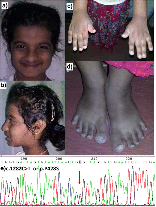 Rubinstein-Taybi syndrome-showing distinctive clinical features