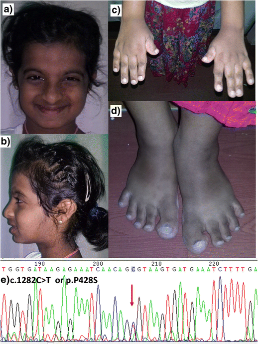 Fetal phenotype of Rubinstein‐Taybi syndrome caused by CREBBP mutations -  Van‐Gils - 2019 - Clinical Genetics - Wiley Online Library