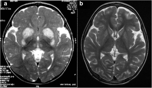 Biotin Thiamin Responsive Basal Ganglia Disease in Siblings | SpringerLink