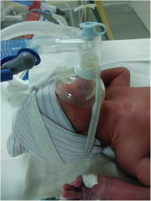 CPAP with Resuscitation Mask in a Neonate with Cleft Lip and Cleft Palate |  SpringerLink