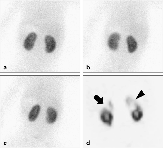 Comparison of Tc-99m DMSA Renal Planar Scan and SPECT for Detection of  Cortical Defects in Infants with Suspected Acute Pyelonephritis |  SpringerLink