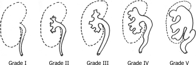 Current Management Of Urinary Tract Infection And Vesicoureteral Reflux Springerlink