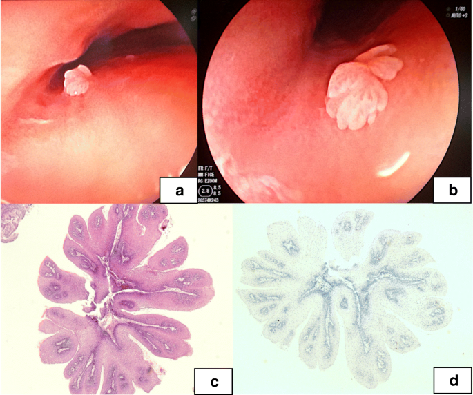 Esophageal squamous papilloma