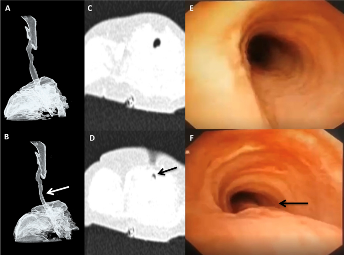 4D Dynamic CT in Children with Stridor: New Non-Invasive Modality for ...