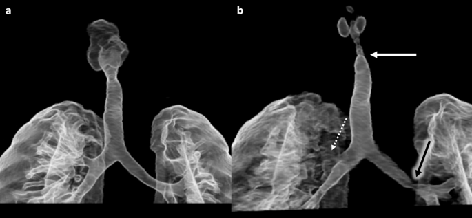 4D Dynamic CT in Children with Stridor: New Non-Invasive Modality for ...