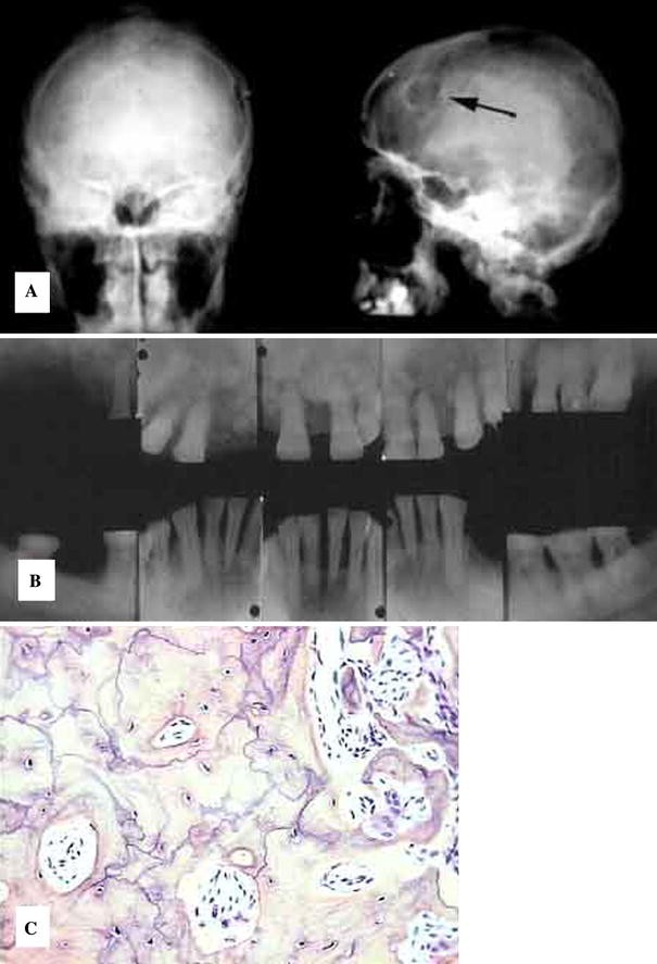 Benign Fibro-Osseous Lesions of the Craniofacial Complex A Review |  SpringerLink