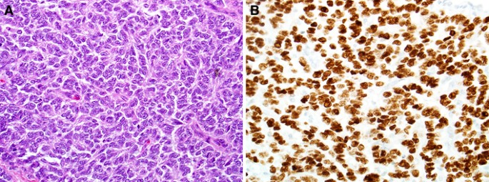 Usefulness of NKX2.2 Immunohistochemistry for Distinguishing Ewing Sarcoma  from Other Sinonasal Small Round Blue Cell Tumors | SpringerLink