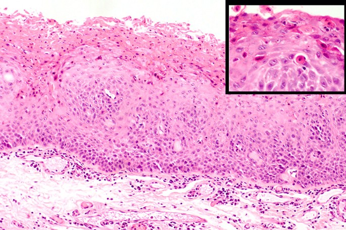 tobacco pouch keratosis histopathology Frictional Keratosis, Contact Keratosis and Smokeless Tobacco Keratosis:  Features of Reactive White Lesions of the Oral Mucosa | Head and Neck  Pathology