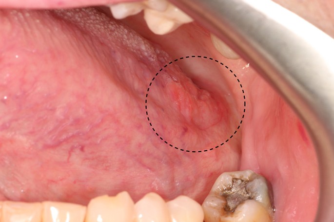 papillary lesion tongue