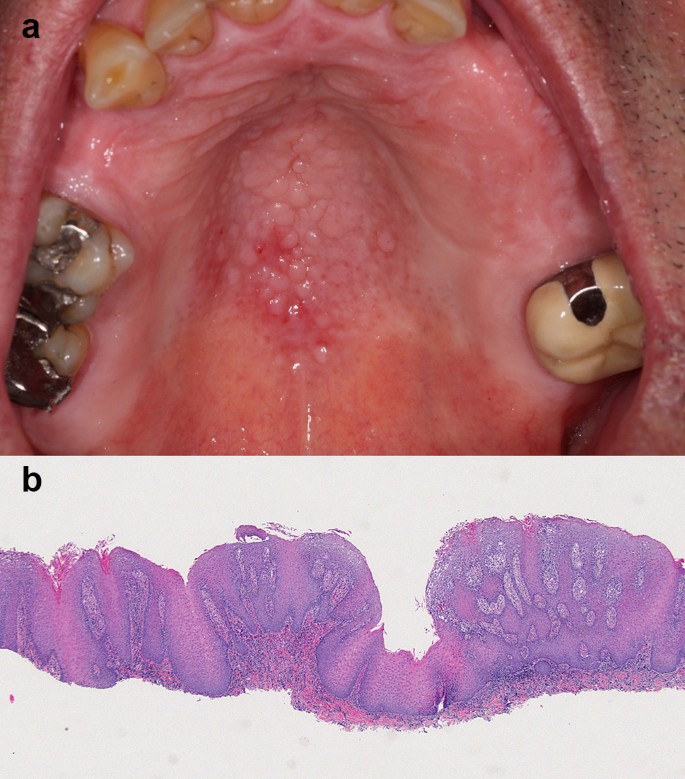 papilloma virus lingua cause