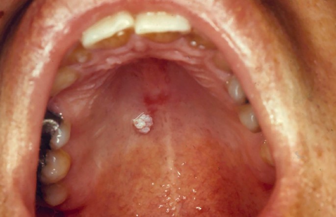 papillomavirus lesion