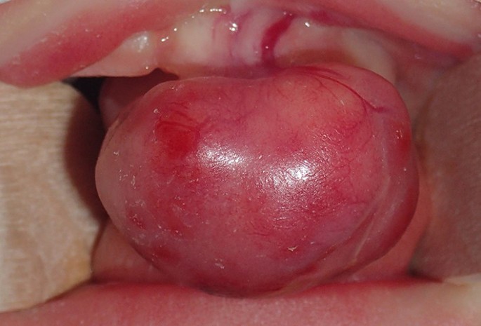 Congenital Granular Cell Epulis: Classic Presentation and Its Differential  Diagnosis | SpringerLink