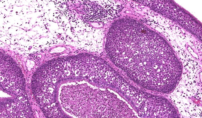 Nasal papilloma growth. Papilloma sinus cancer Hpv sinus tumor