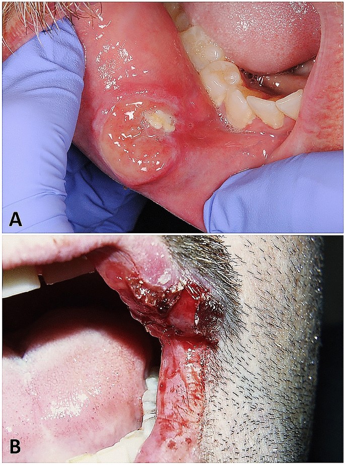 Oral Manifestations of Syphilis-Syphilis-Causes-Symptoms-Diagnosis-Treatment-Homeopathic-Allopathic-Dr-Qaisar-Ahmed-Al Haytham-Clinic-Risalpur-KPK-Pakistan