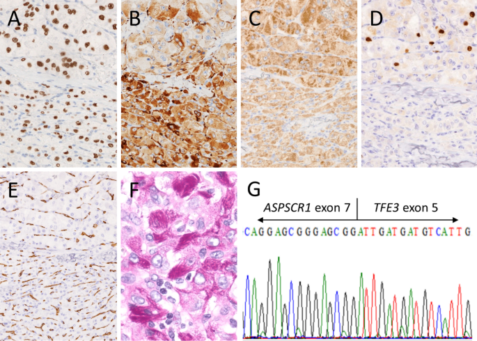 Primary Alveolar Soft Part Sarcoma Of Cheek Report Of A Case And Review Of The Literature Springerlink