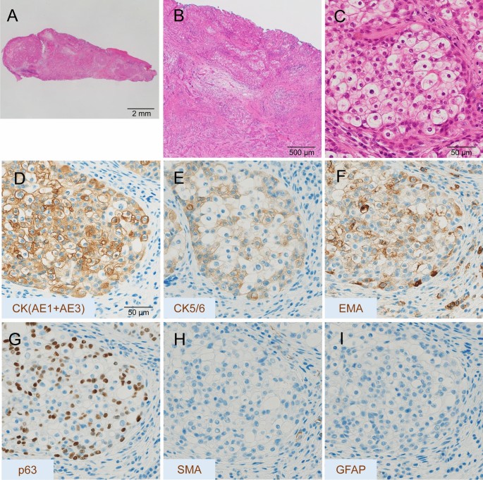 Clear Cell Carcinoma In The Oral Cavity With Three Novel Types Of Ewsr1 Atf1 Translocation A Case Report Springerlink