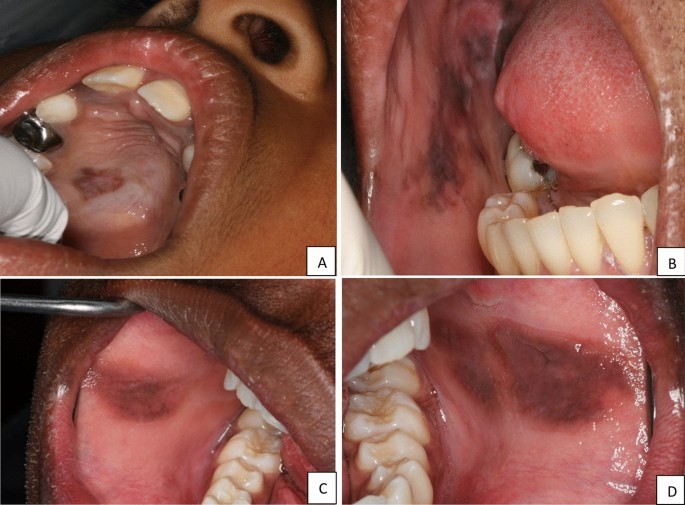 melanotic macule on tongue Tongue Melanotic Macule