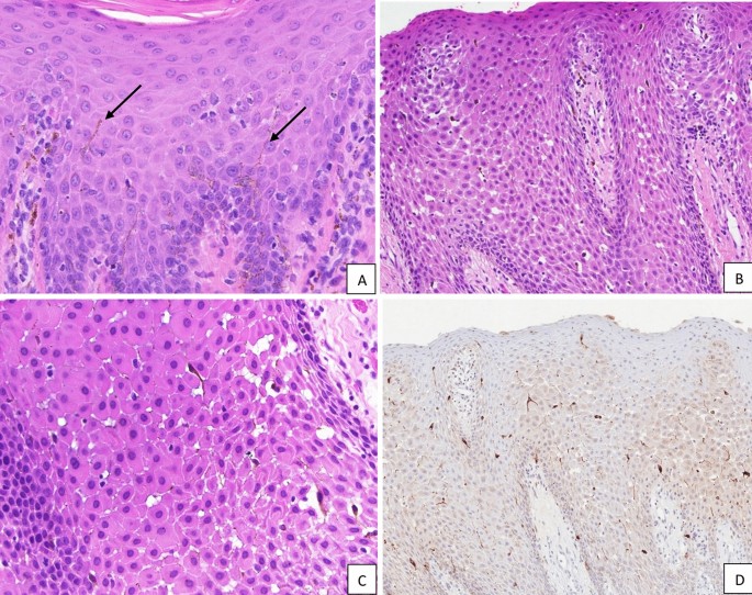 Oral Melanoacanthoma: Case Series of 33 Cases and Review of the Literature  | Head and Neck Pathology | Springer Nature Link