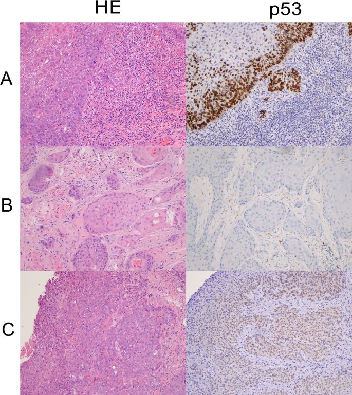 Simultaneous p53 and p16 Immunostaining for Molecular Subclassification ...