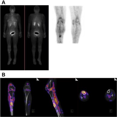 Molecular imaging in musculoskeletal infections with 99mTc-UBI 29-41  SPECT/CT | SpringerLink
