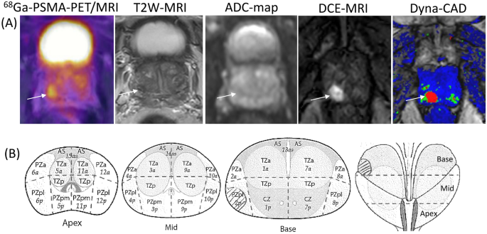 Dfw Mri Christmas Party 2022 Diagnostic Efficiency Of Hybrid Imaging Using Psma Ligands, Pet/Ct, Pet/Mri  And Mri In Identifying Malignant Prostate Lesions | Springerlink