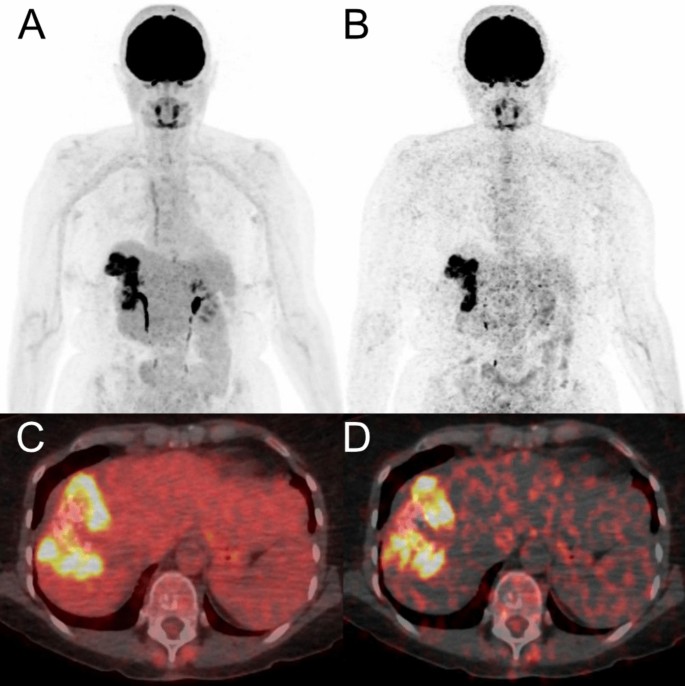 Whole-body dynamic FDG-PET/CT parametric imaging in alveolar ...