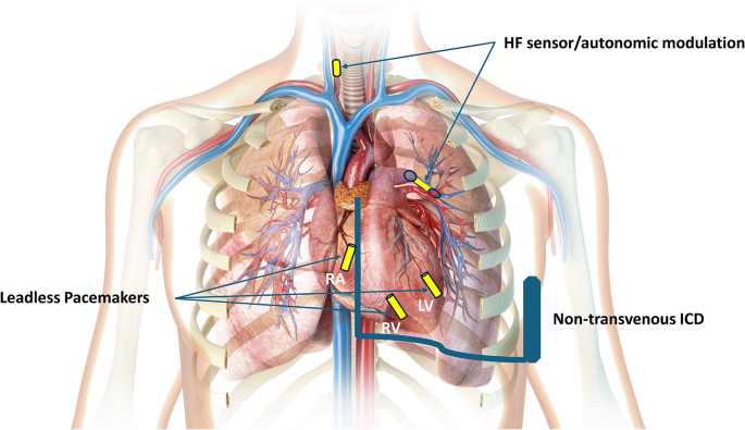 Leadless Pacemaker Location Leadless Pacemakers: A Contemporary Review | Current Cardiovascular ...