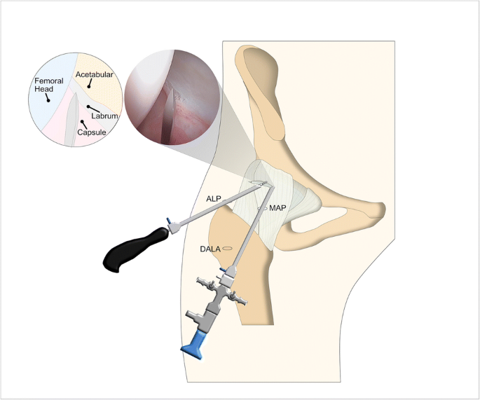 Contemporary Management Of The Hip Capsule During Arthroscopic Hip Preservation Surgery Springerlink