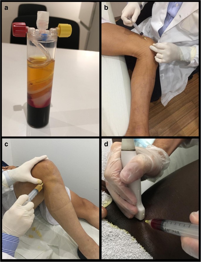 The Clinical Use of Biologics in the Knee Lesions: Does the ...