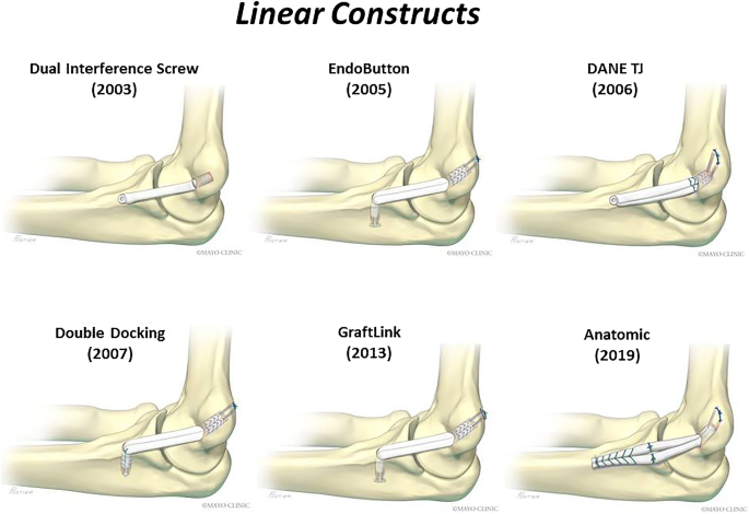 The History And Evolution Of Elbow Medial Ulnar Collateral Ligament Reconstruction From Tommy John To 2020 Springerlink