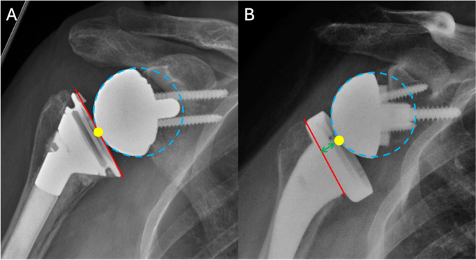 Stem Reverse Shoulder Humeral Stem Design in Reverse Total Shoulder Arthroplasty | Current ...