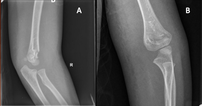 Nonoperative Management of Gartland Type II Supracondylar Humeral ...