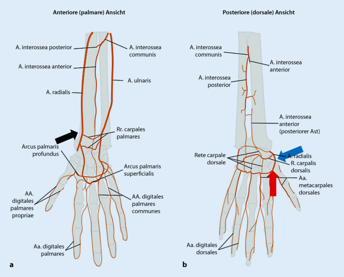 Ein neuer Weg zum Herz durch die distale Arteria radialis | SpringerLink