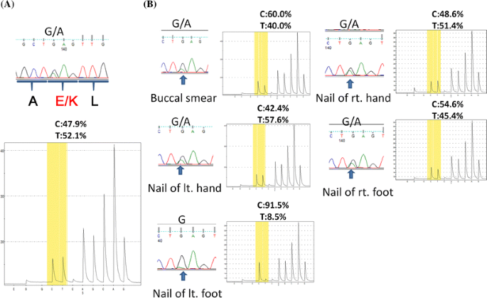 Serial Investigation Of Ptpn11 Mutation In Nonhematopoietic Tissues In A Patient With Juvenile Myelomonocytic Leukemia Who Was Treated With Unrelated Cord Blood Transplantation Springerlink