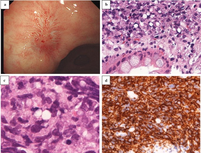Signet ring cell “lymphoma”: mimicking the appearance of signet ring cell  carcinoma | SpringerLink
